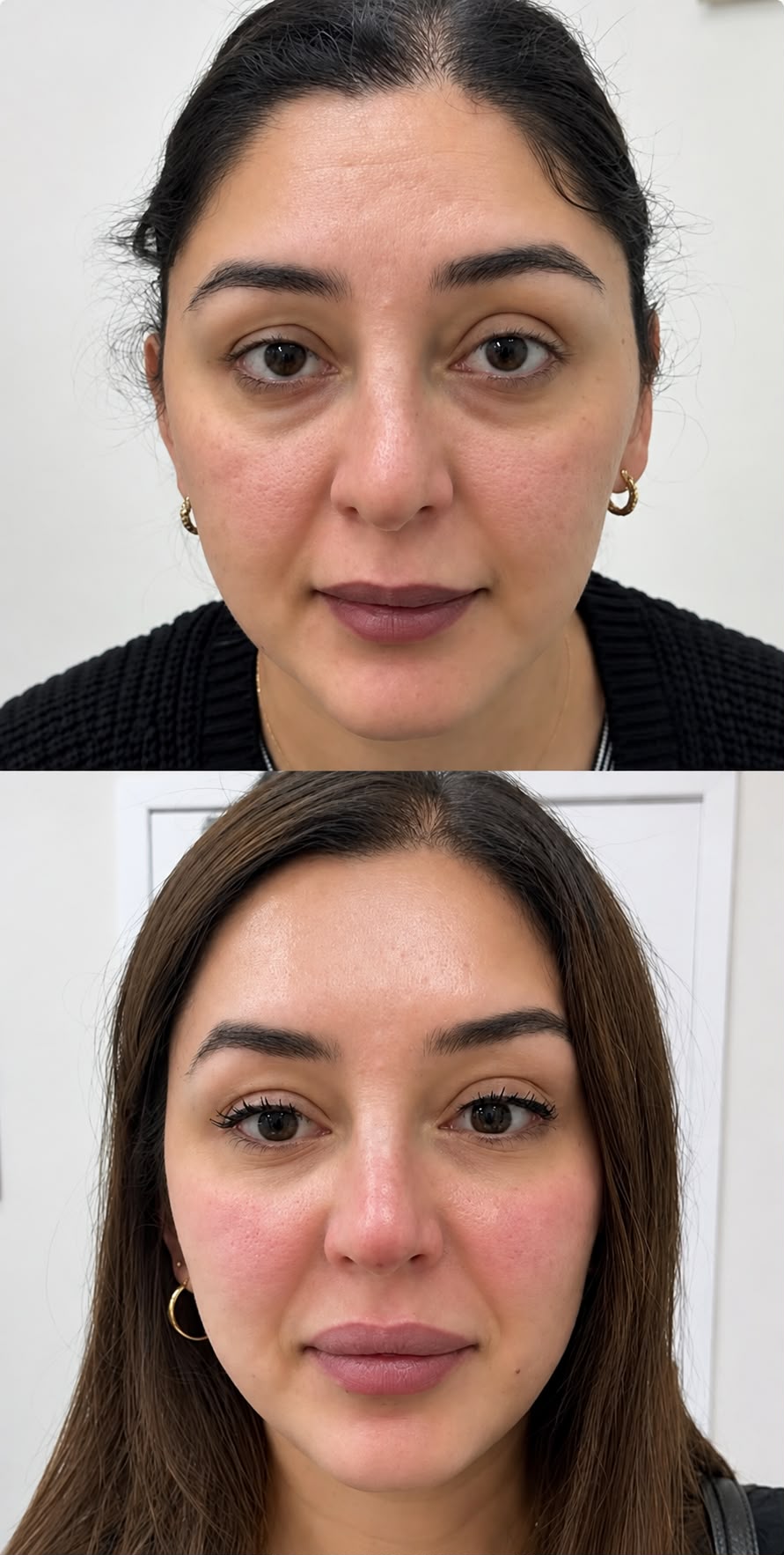 derma filler before and after