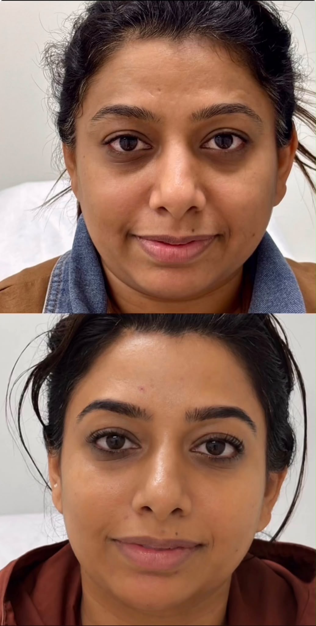 liquid rhinoplasty before and after