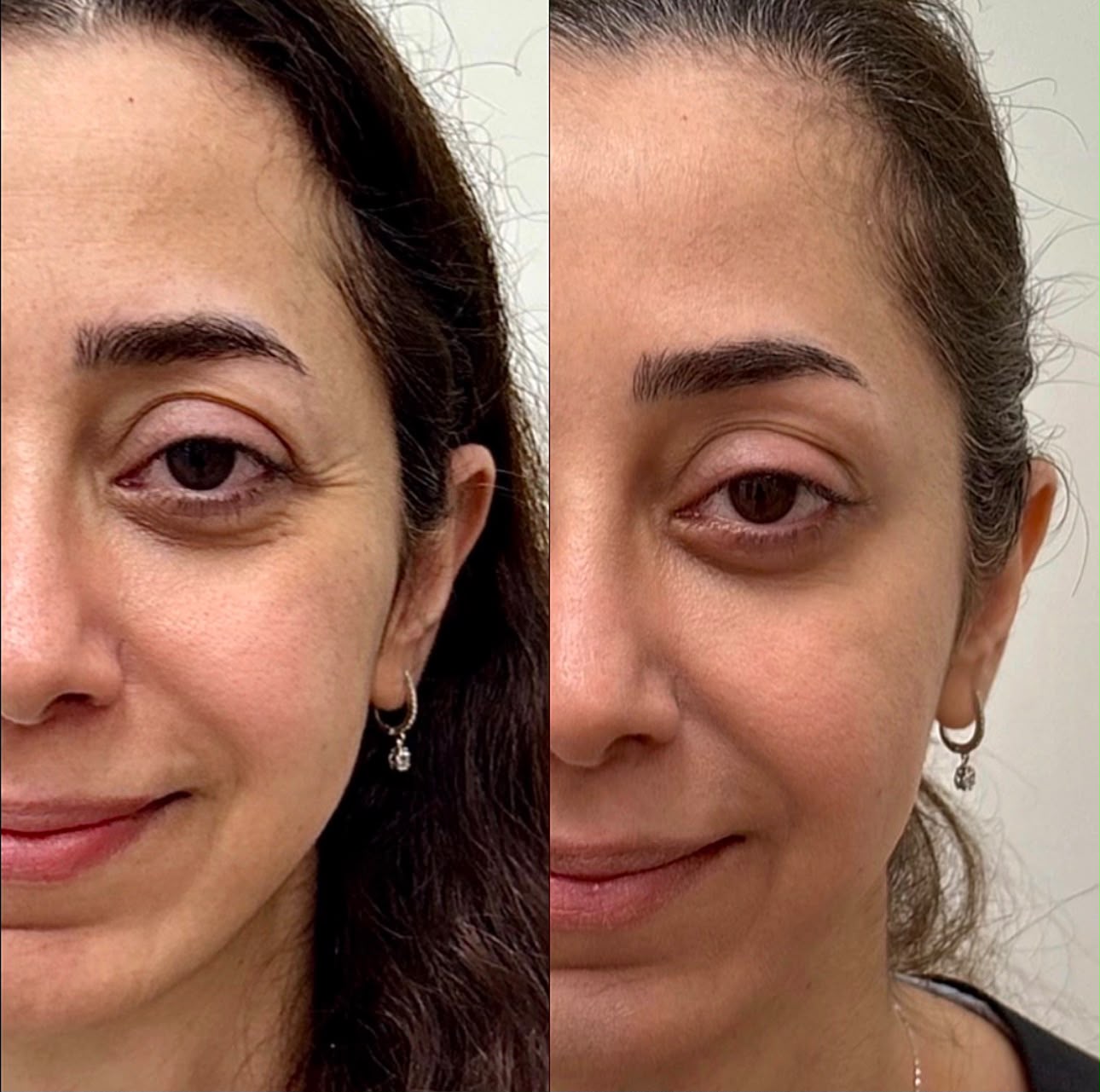 botox around the eyes before and after