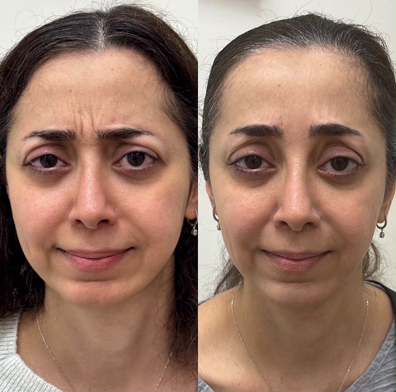 botox forehead before and after