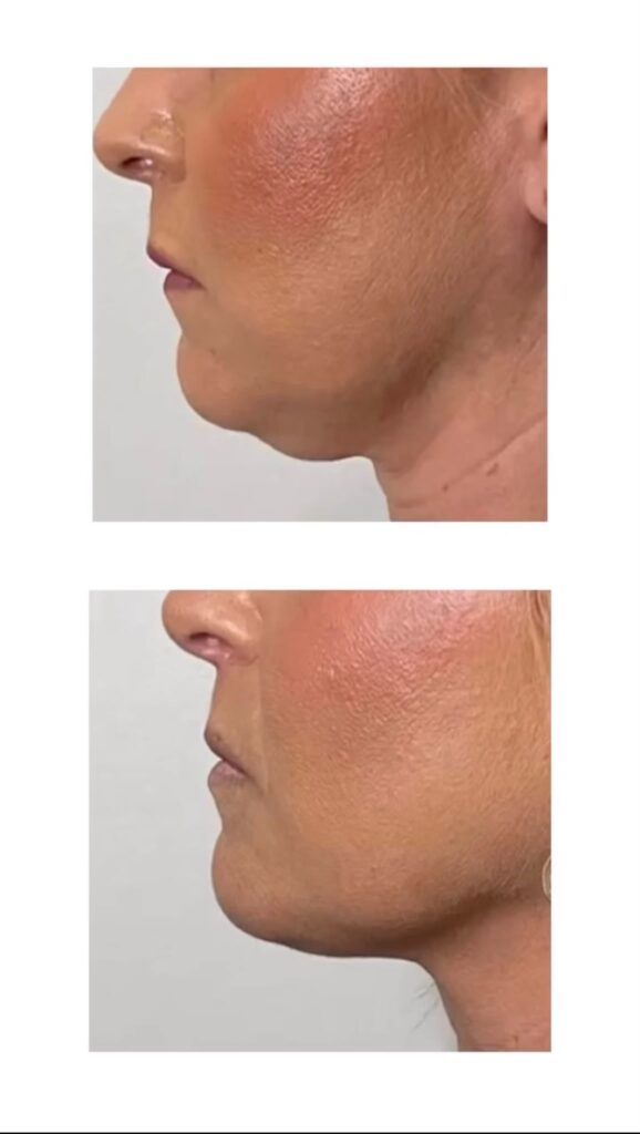 double chin belkyra before and after treatment