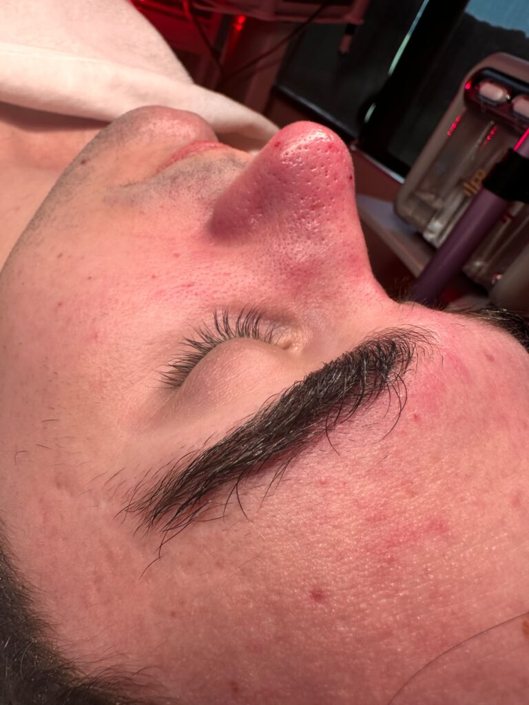 dermaplaning facial treatment at skin excellence medispa