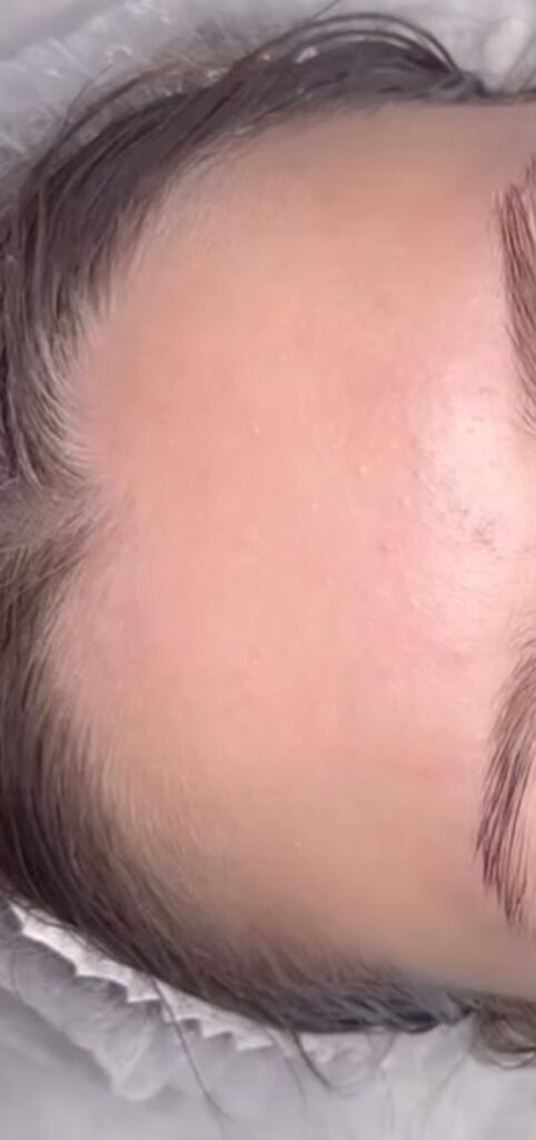 dermaplaning forehead treatment at skin excellence medispa